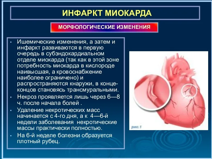 ИНФАРКТ МИОКАРДА Ишемические изменения, а затем и инфаркт развиваются в первую