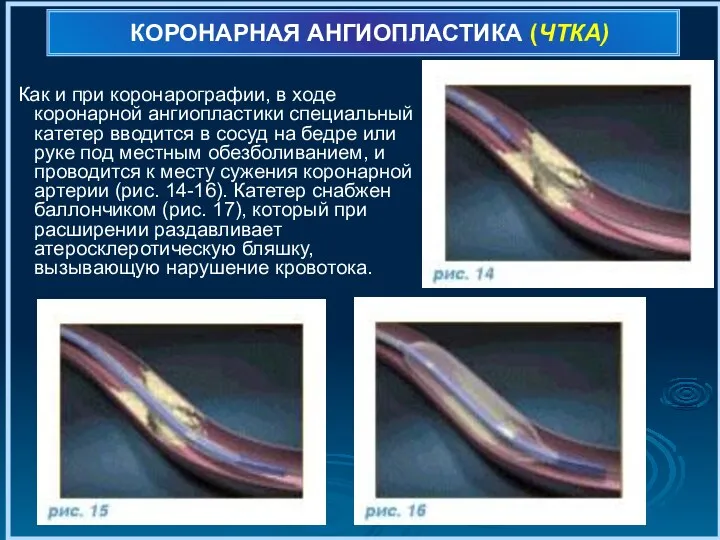 КОРОНАРНАЯ АНГИОПЛАСТИКА (ЧТКА) Как и при коронарографии, в ходе коронарной ангиопластики