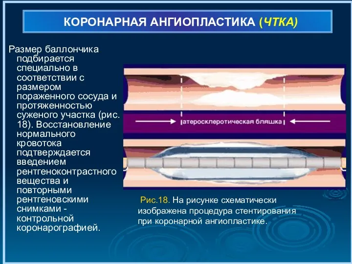 КОРОНАРНАЯ АНГИОПЛАСТИКА (ЧТКА) Размер баллончика подбирается специально в соответствии с размером