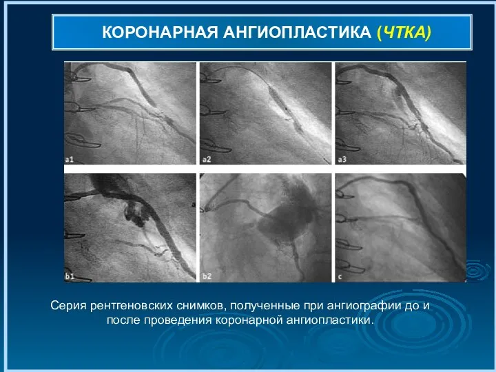 КОРОНАРНАЯ АНГИОПЛАСТИКА (ЧТКА) Серия рентгеновских снимков, полученные при ангиографии до и после проведения коронарной ангиопластики.