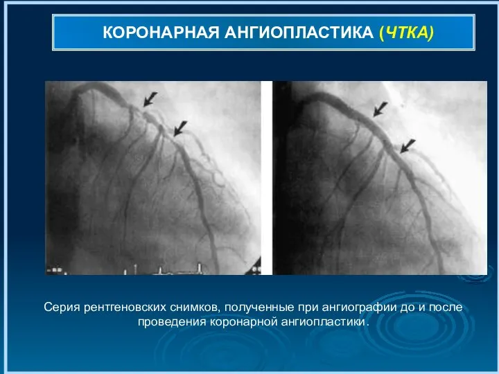 КОРОНАРНАЯ АНГИОПЛАСТИКА (ЧТКА) Серия рентгеновских снимков, полученные при ангиографии до и после проведения коронарной ангиопластики.