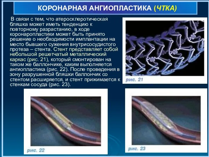 КОРОНАРНАЯ АНГИОПЛАСТИКА (ЧТКА) В связи с тем, что атеросклеротическая бляшка может