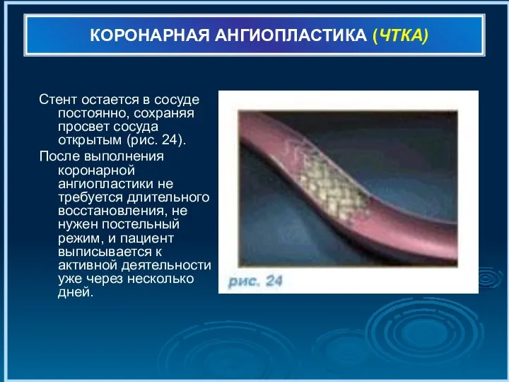 КОРОНАРНАЯ АНГИОПЛАСТИКА (ЧТКА) Стент остается в сосуде постоянно, сохраняя просвет сосуда