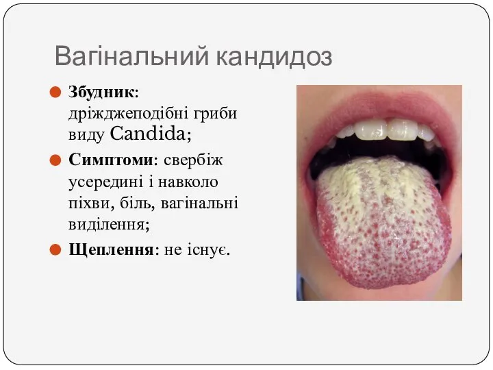 Вагінальний кандидоз Збудник: дріжджеподібні гриби виду Candida; Симптоми: свербіж усередині і