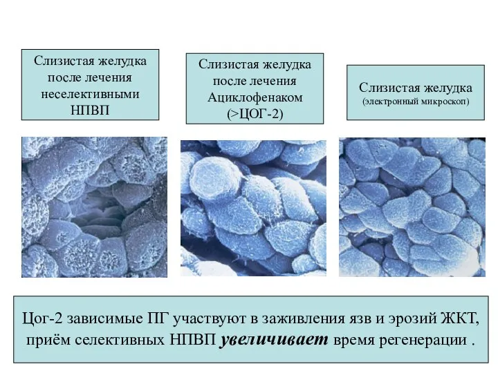 Слизистая желудка (электронный микроскоп) Слизистая желудка после лечения неселективными НПВП Слизистая