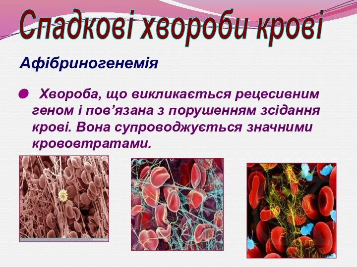 Афібриногенемія Хвороба, що викликається рецесивним геном і пов’язана з порушенням зсідання