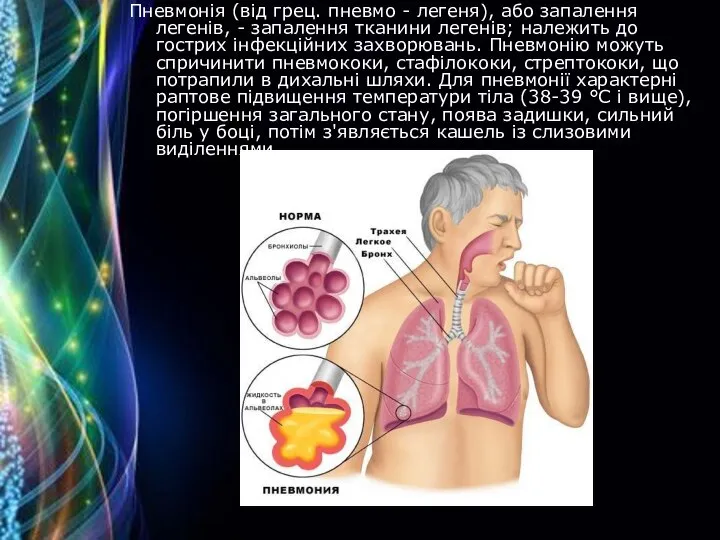 Пневмонія (від грец. пневмо - легеня), або запалення легенів, - запалення