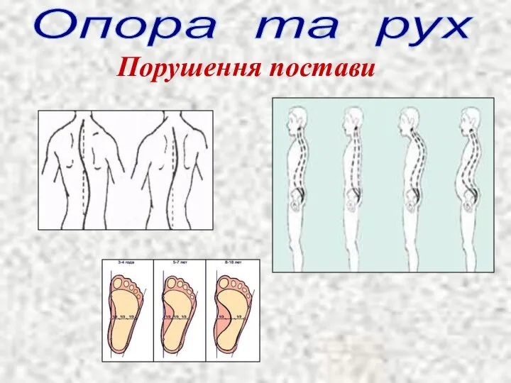 Опора та рух Порушення постави