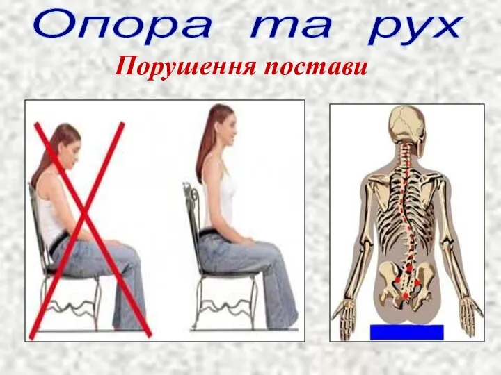 Опора та рух Порушення постави