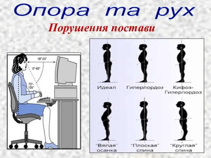 Опора та рух Порушення постави