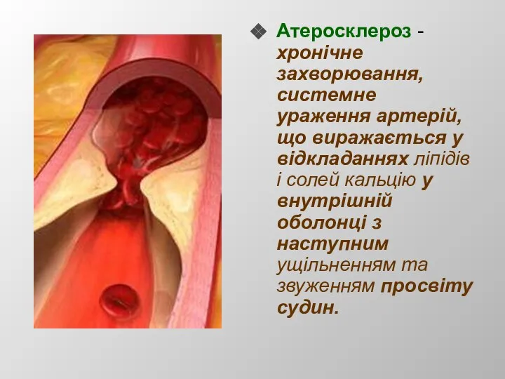 Атеросклероз - хронічне захворювання, системне ураження артерій, що виражається у відкладаннях