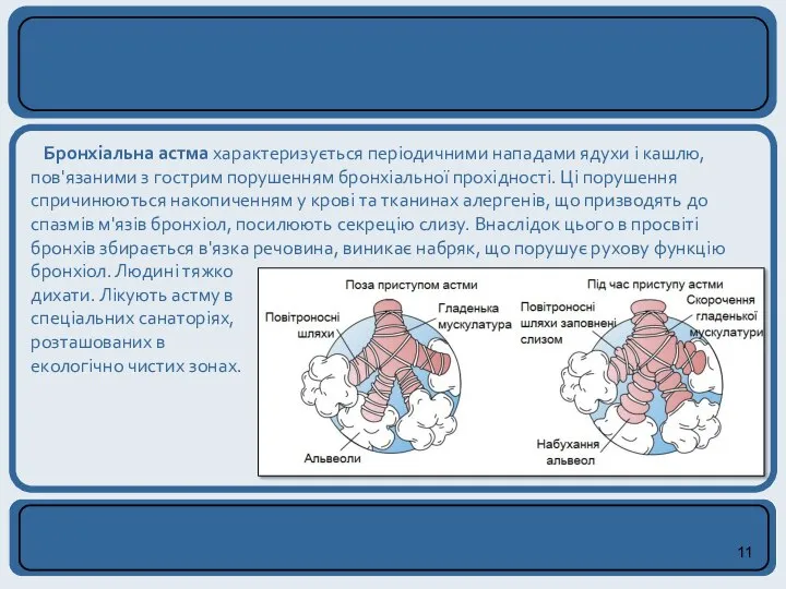Бронхіальна астма характеризується періодичними нападами ядухи і кашлю, пов'язаними з гострим