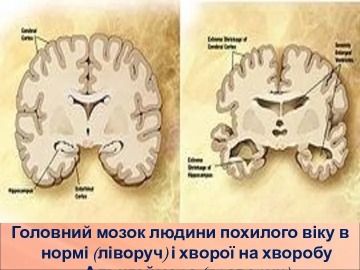 Головний мозок людини похилого віку в нормі (ліворуч) і хворої на хворобу Альцгеймера (праворуч)