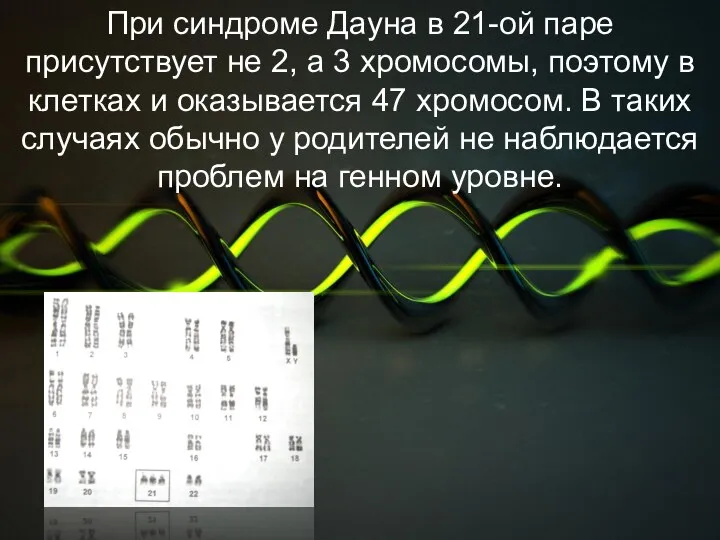 При синдроме Дауна в 21-ой паре присутствует не 2, а 3