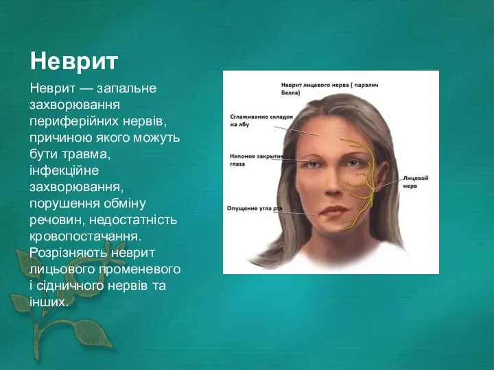 Неврит Неврит — запальне захворювання периферійних нервів, причиною якого можуть бути