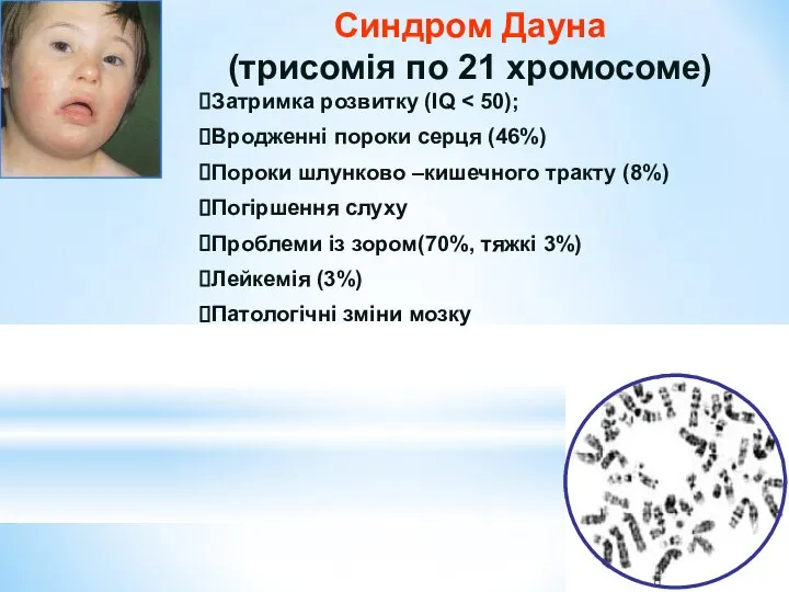 Синдром Дауна (трисомія по 21 хромосоме) Затримка розвитку (IQ Вродженні пороки