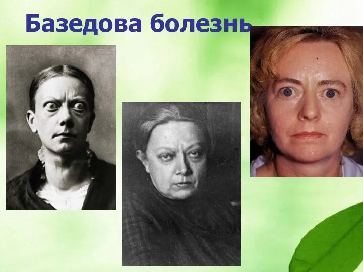 Базедова болезнь