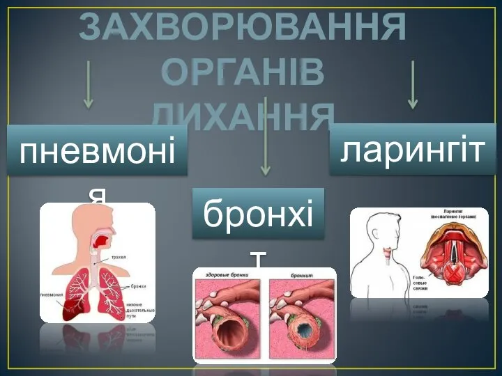 ЗАХВОРЮВАННЯ ОРГАНІВ ДИХАННЯ ларингіт бронхіт пневмонія