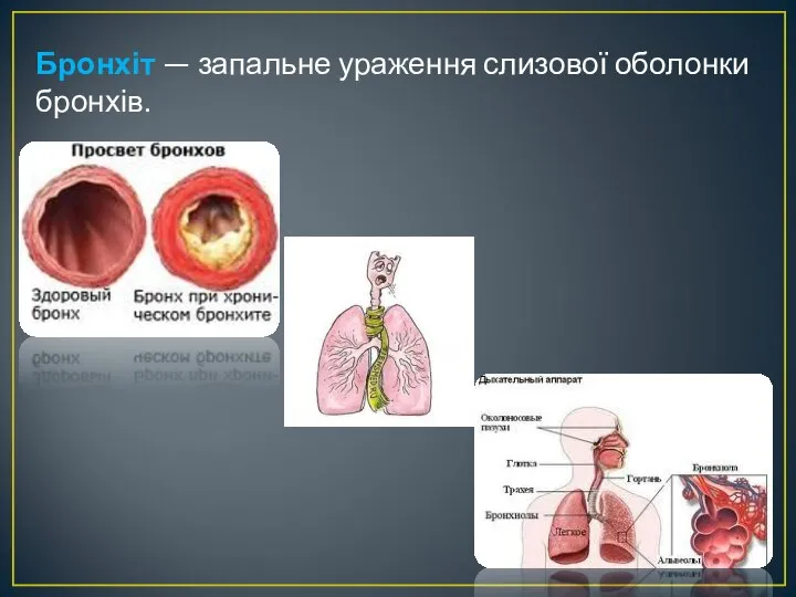 Бронхіт — запальне ураження слизової оболонки бронхів.