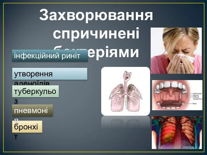 Захворювання спричинені бактеріями інфекційний риніт утворення аденоїдів туберкульоз бронхіт пневмонія