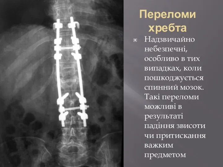 Переломи хребта Надзвичайно небезпечні, особливо в тих випадках, коли пошкоджується спинний