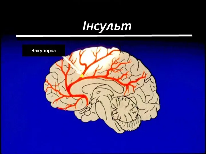 Інсульт Закупорка