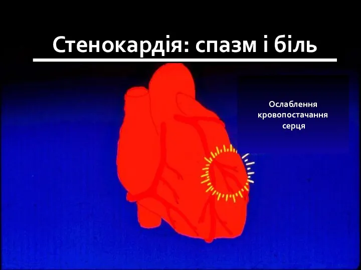 Ослаблення кровопостачання серця Стенокардія: спазм і біль