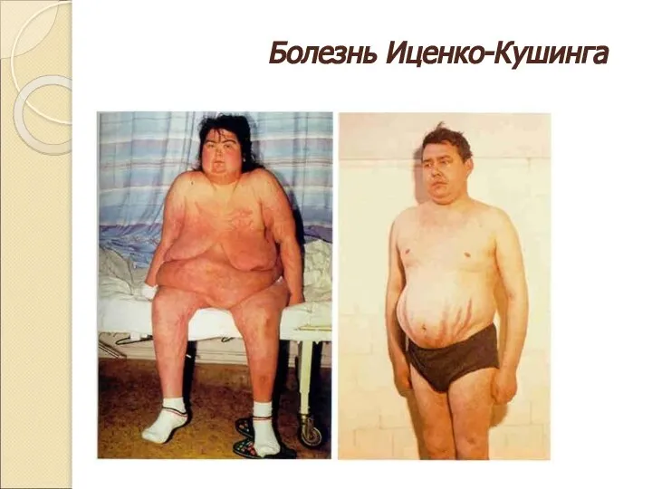 Болезнь Иценко-Кушинга