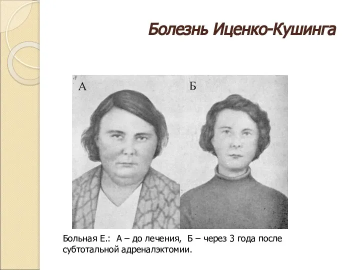 Болезнь Иценко-Кушинга Больная Е.: А – до лечения, Б – через 3 года после субтотальной адреналэктомии.