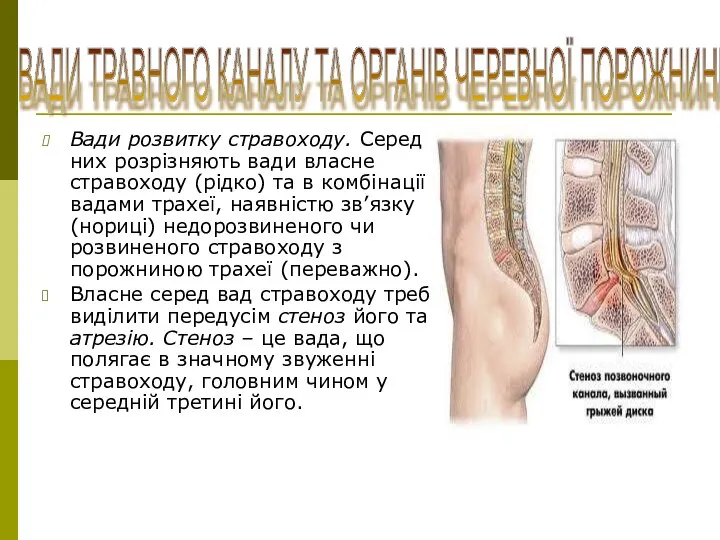 Вади розвитку стравоходу. Серед них розрізняють вади власне стравоходу (рідко) та