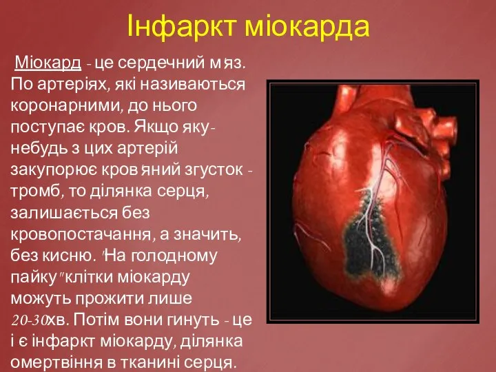 Інфаркт міокарда Міокард - це сердечний м'яз. По артеріях, які називаються