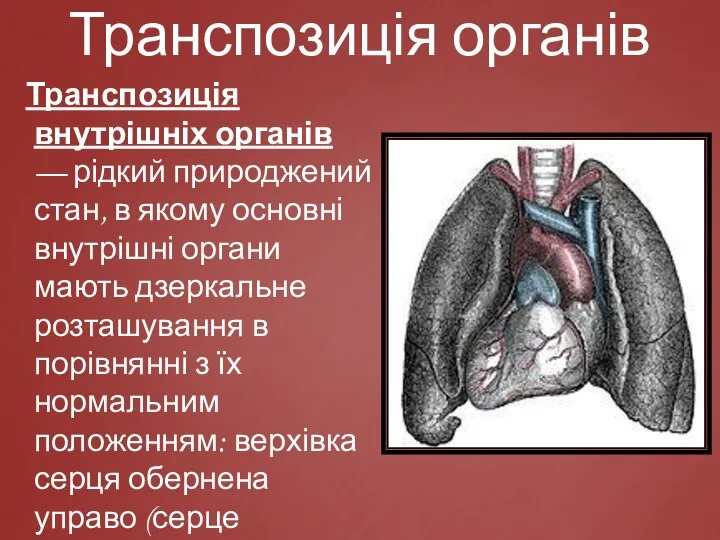 Транспозиція органів Транспозиція внутрішніх органів — рідкий природжений стан, в якому