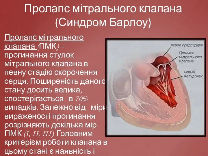 Пролапс мітрального клапана (Синдром Барлоу) Пролапс мітрального клапана (ПМК) – прогинання