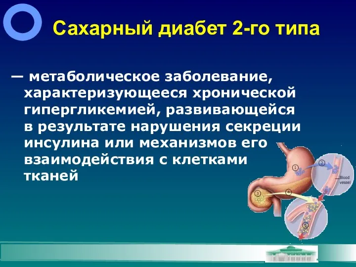 Сахарный диабет 2-го типа — метаболическое заболевание, характеризующееся хронической гипергликемией, развивающейся