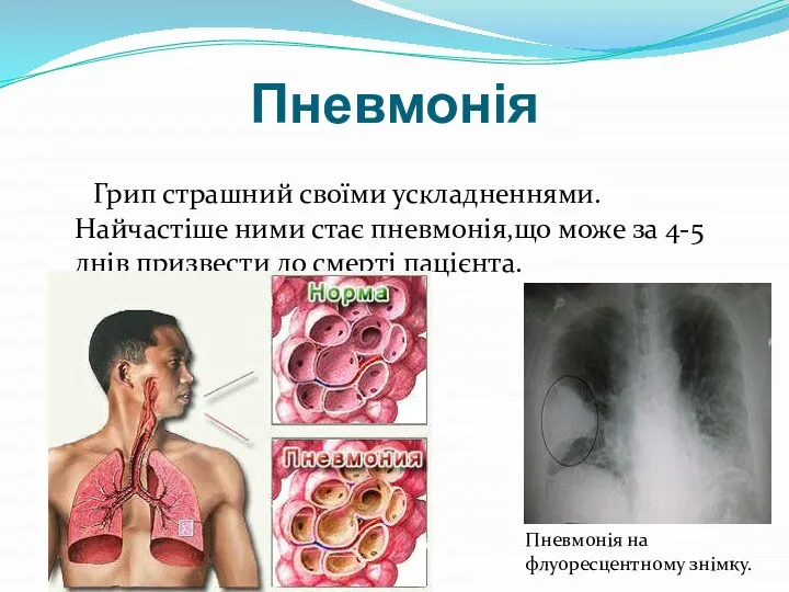 Пневмонія Грип страшний своїми ускладненнями. Найчастіше ними стає пневмонія,що може за