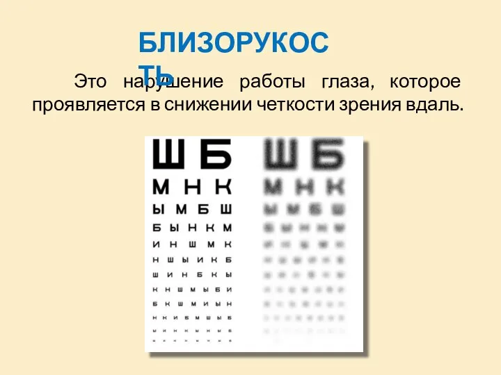 Это нарушение работы глаза, которое проявляется в снижении четкости зрения вдаль. БЛИЗОРУКОСТЬ