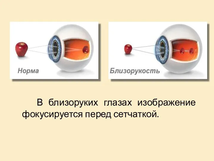 В близоруких глазах изображение фокусируется перед сетчаткой.