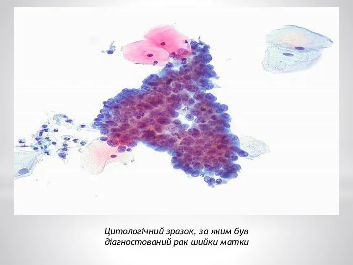 Цитологічний зразок, за яким був діагностований рак шийки матки