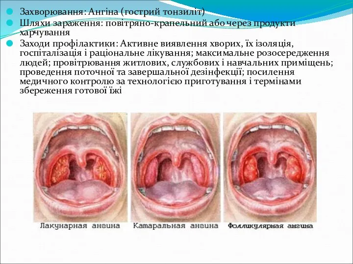 Захворювання: Ангіна (гострий тонзиліт) Шляхи зараження: повітряно-крапельний або через продукти харчування