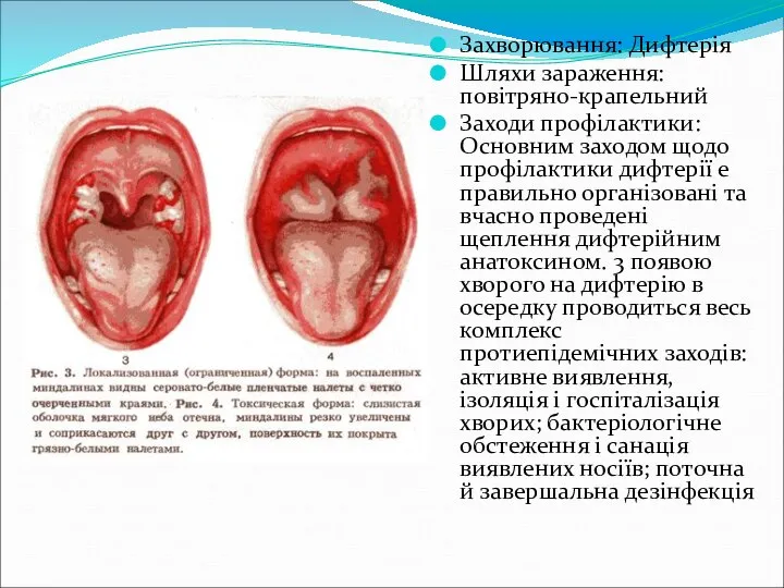 Захворювання: Дифтерія Шляхи зараження: повітряно-крапельний Заходи профілактики: Основним заходом щодо профілактики