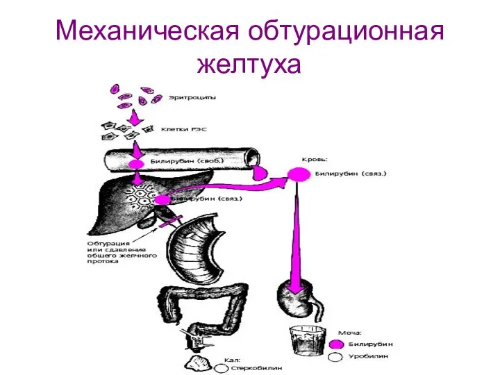 Механическая обтурационная желтуха