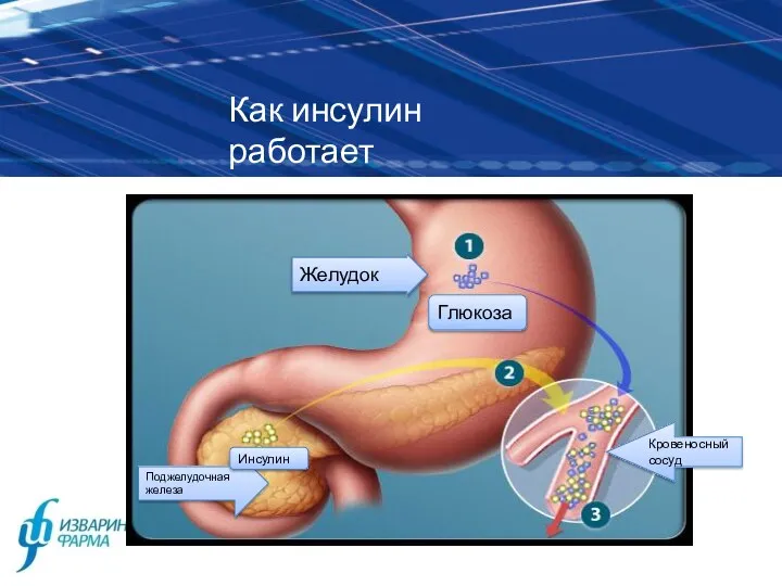 Как инсулин работает Желудок Глюкоза Поджелудочная железа Инсулин Кровеносный сосуд