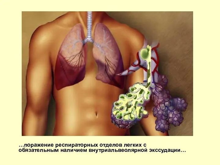 …поражение респираторных отделов легких с обязательным наличием внутриальвеолярной экссудации…