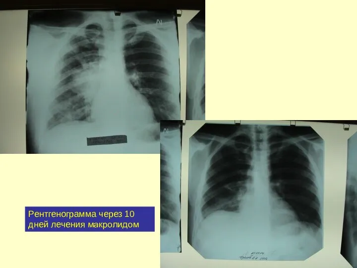 Рентгенограмма через 10 дней лечения макролидом
