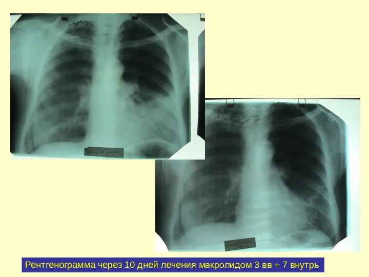 Рентгенограмма через 10 дней лечения макролидом 3 вв + 7 внутрь