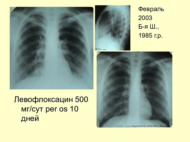 Левофлоксацин 500 мг/сут per os 10 дней Февраль 2003 Б-я Ш., 1985 г.р.