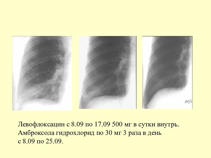 Левофлоксацин с 8.09 по 17.09 500 мг в сутки внутрь. Амброксола