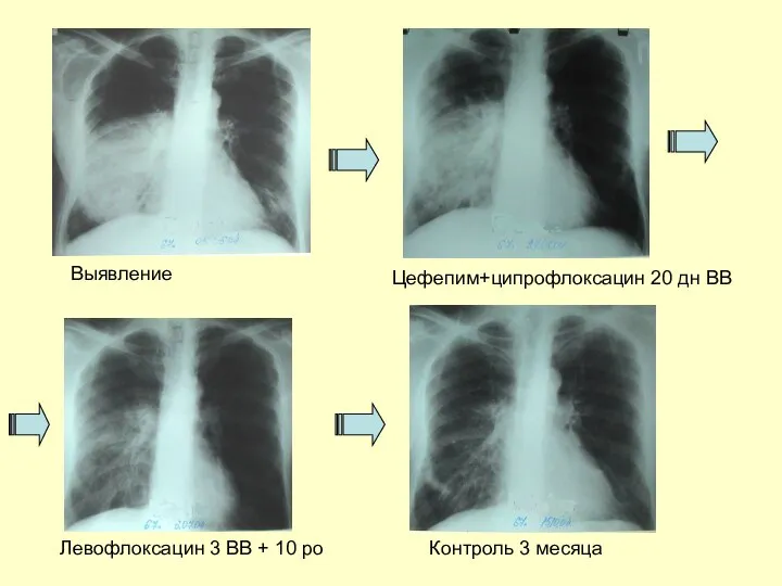 Выявление Цефепим+ципрофлоксацин 20 дн ВВ Левофлоксацин 3 ВВ + 10 po Контроль 3 месяца