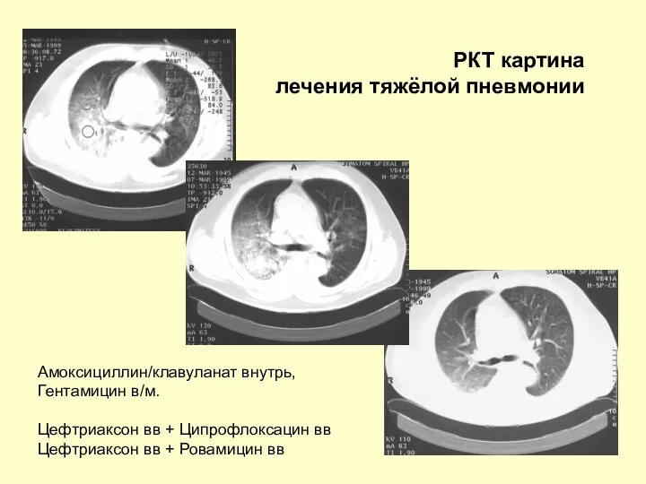 РКТ картина лечения тяжёлой пневмонии Амоксициллин/клавуланат внутрь, Гентамицин в/м. Цефтриаксон вв