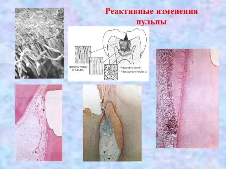 Реактивные изменения пульпы